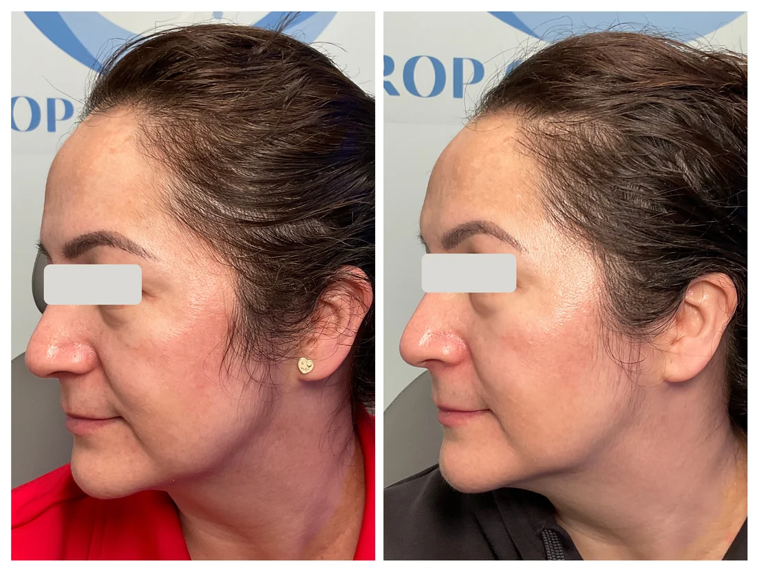 CoolPeel CO2 laser before and after at Drop of Paradise med spa, El Cerrito CA — individual results vary