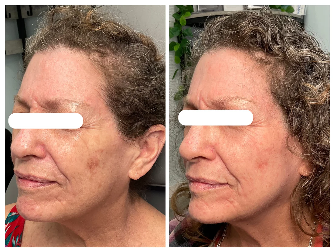 CoolPeel CO2 laser skin resurfacing before and after at Drop of Paradise med spa, El Cerrito CA — individual results vary