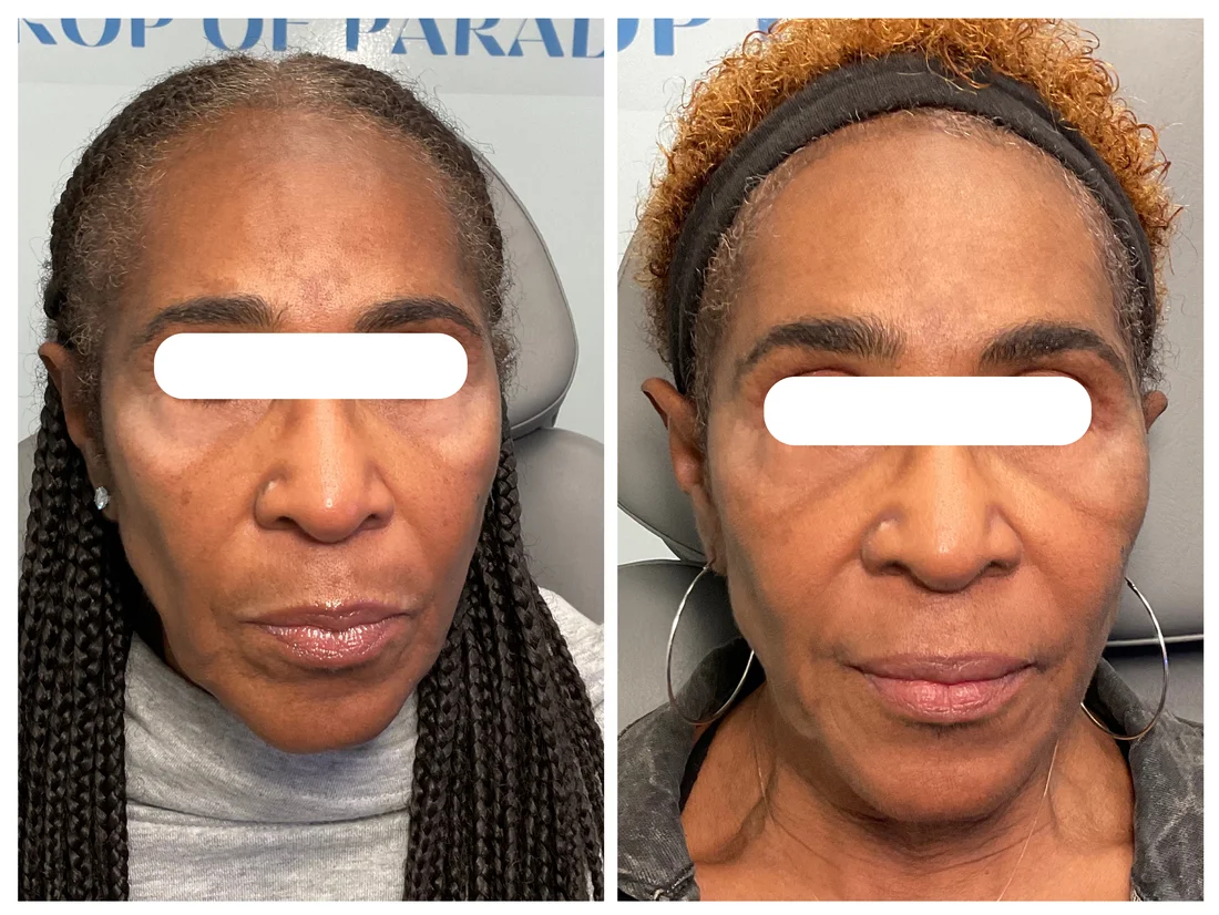 CoolPeel DEKA CO2 laser before and after at Drop of Paradise med spa, El Cerrito CA — individual results vary