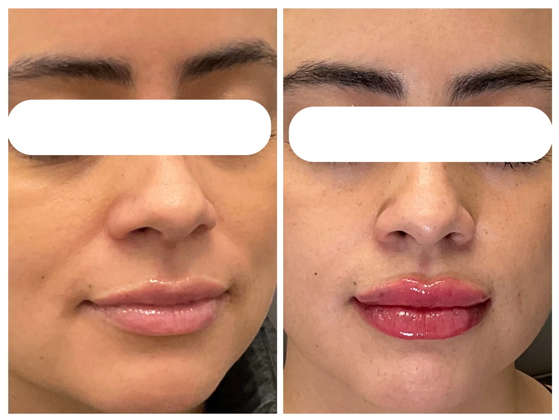 Lip filler before and after at Drop of Paradise med spa, El Cerrito CA — individual results vary
