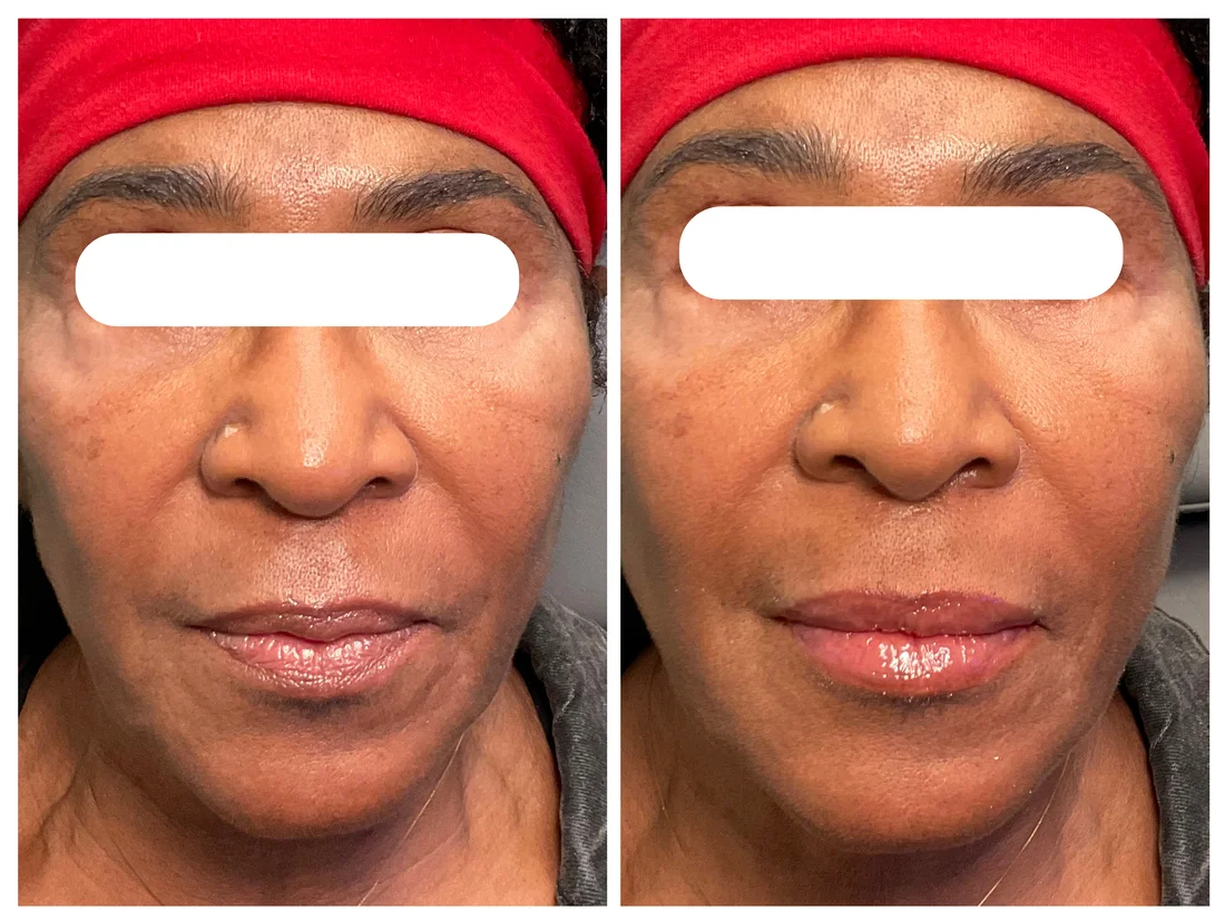 Lip filler before and after at Drop of Paradise med spa, El Cerrito CA — individual results vary