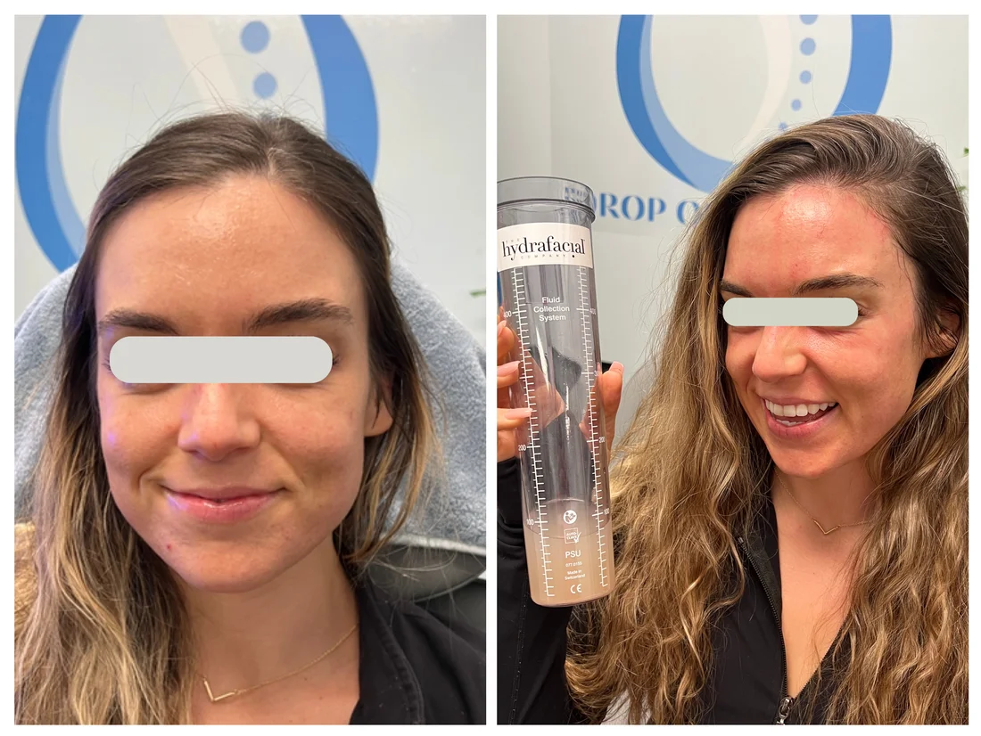 Hydraneedle HydraFacial and microneedling before and after at Drop of Paradise med spa, El Cerrito CA — individual results vary