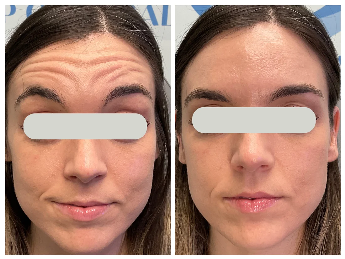 Neurotoxin (Jeuveau / Daxxify) forehead before and after at Drop of Paradise med spa, El Cerrito CA — individual results vary