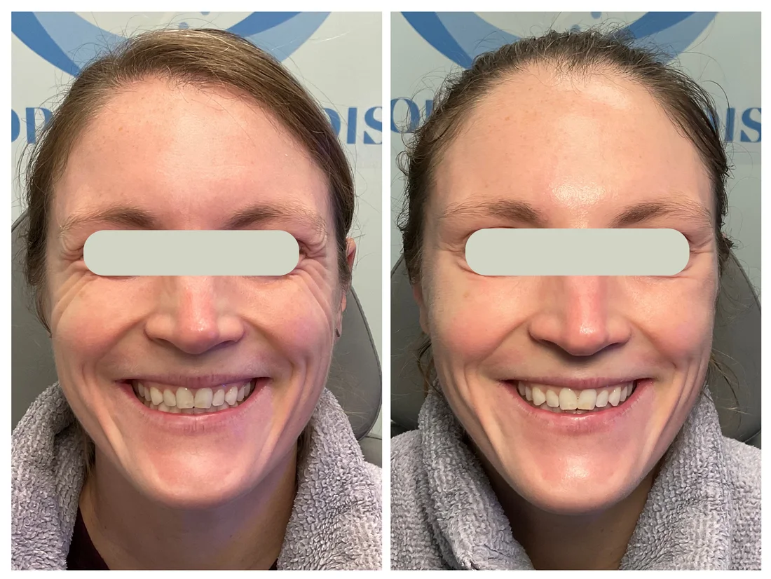 Neurotoxin (Jeuveau / Daxxify) before and after at Drop of Paradise med spa, El Cerrito CA — individual results vary